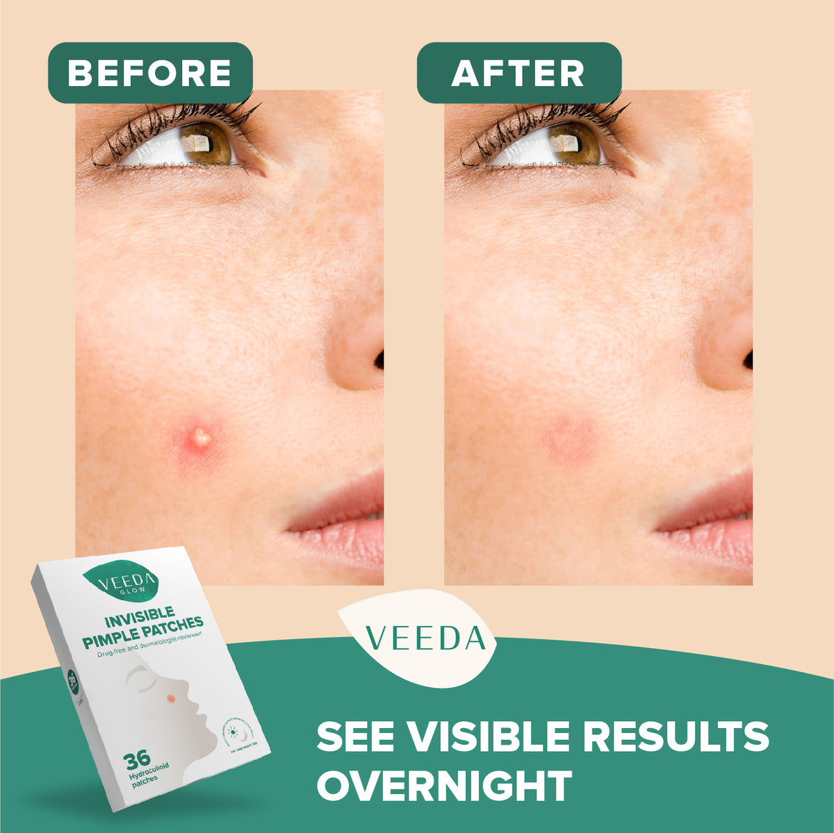 Veeda Glow Invisible Hydrocolloid Pimple Patches